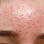 Chăm Sóc Da Dầu Mụn Đầu Đen Phổ Biến Nhất Hiện Nay Sau 7 Ngày