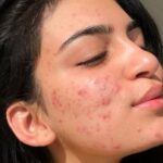 Mẹo Chăm Sóc Da Mụn Đầu Đen Da Dầu Lỗ Chân Lông To Tại Nhà