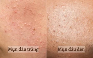 Top 6 cách chăm sóc da mụn tuổi dậy thì