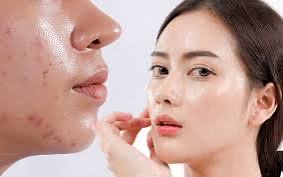 Cách Chăm Sóc Cho Da Dầu Dị Ứng Hiện Quả Sau 24h Tại Nhà .